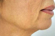 Ultrasound and Radio Frequency Body Contouring Results