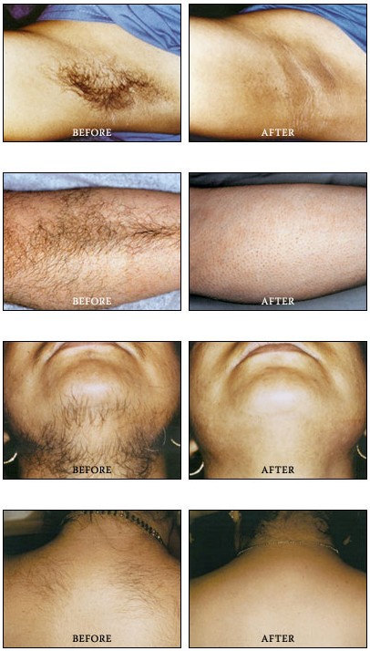 Laser Hair Removal Results